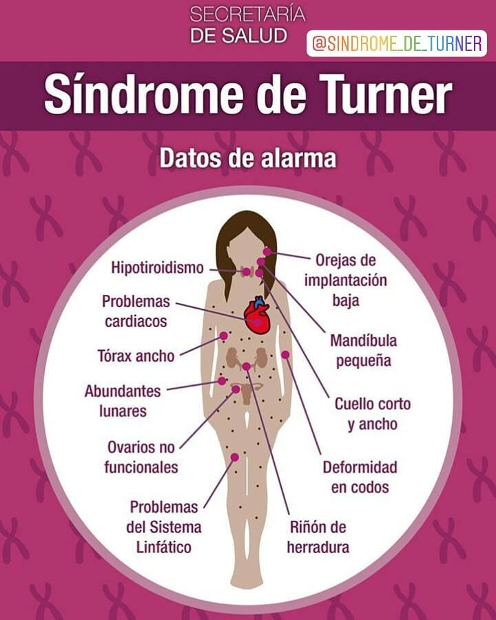 Festeja el día mundial del síndrome de Turner aprendiendo sobre él